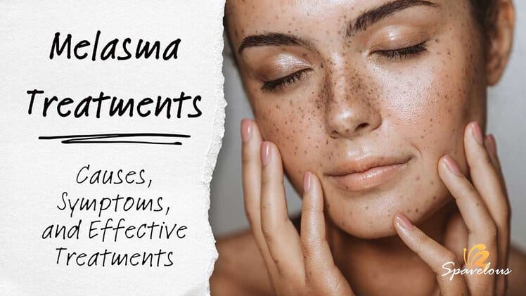 Melasma From Birth Control: Causes, Symptoms, Treatment – TUYDC