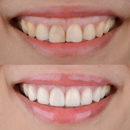 Porcelain Veneers in Scottsdale, AZ