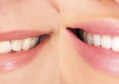 Changes to the upper lip