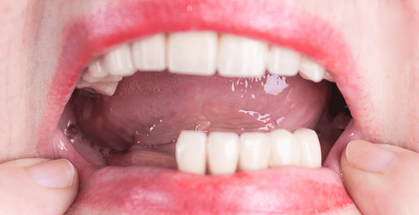 Dental Bridges in Syracuse, NY | Book a Free Implant Consultation