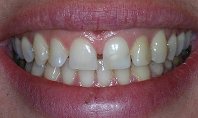 Before porcelain veneers vs dental bonding