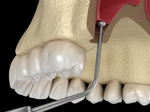 Sinus Lift in Ontario, CA | Book a FREE Consultation Today!