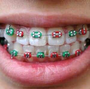 ortodontia la copii aparate dentare1 ortodontia la copii aparate dentare1