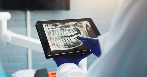 Qué pasa si no tengo suficiente hueso para un implante dental | Mini Implantes en Carolina del Norte