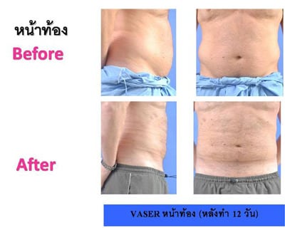 vaser-liposuction1_mini