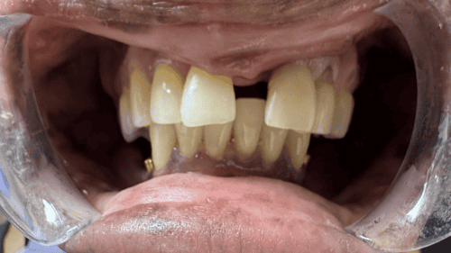 Mini Dental Implants in Scottsdale, AZ Dr. Seerat Mann