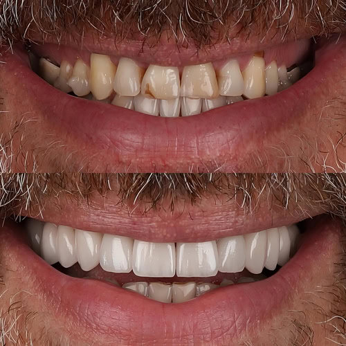 Instant Orthodontics in Wayne, NJ | Affordable Dental Veneers