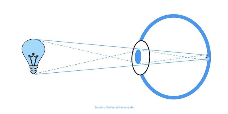 Lasertag - Abbildung einer normalen Lichtquelle auf der Netzhaut