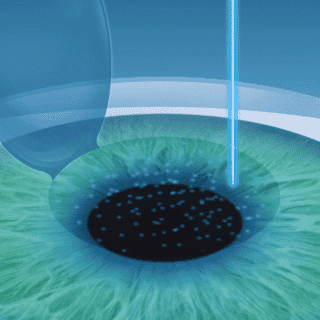Lasermethoden 2 Femto_Lasik