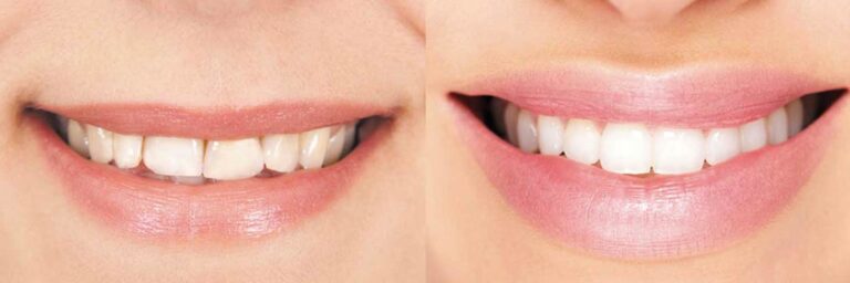 Lifting de la lèvre supérieure à Paris