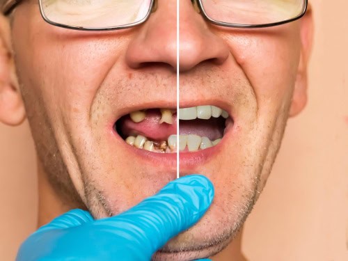 Implant Dentist in Las Vegas Dr. Harvey Chin Free Consultations