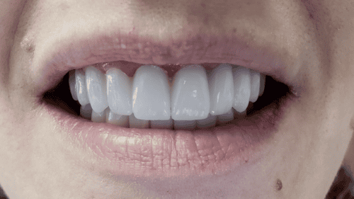 01 After Mini Dental Implants in Scottsdale, AZ Dr. Seerat Mann