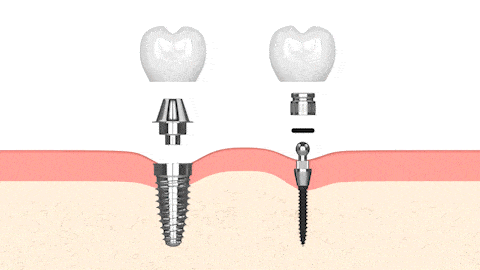 Mini Dental Implants in Salt Lake City, UT | Dr. Ruedi Tillmann