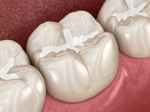 Selladores Dentales en Ontario, CA Esparza Dentistry