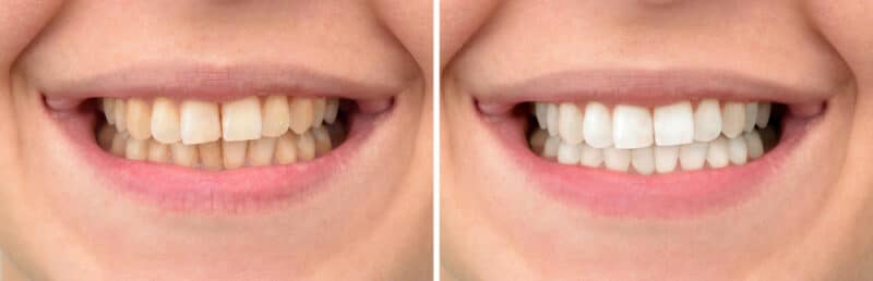 What are the Causes of Teeth Stains | Carolina Dental Arts