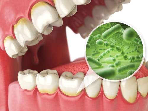 Gingivitis Treatment in Dallas, TX | Affordable Gum Disease Relief