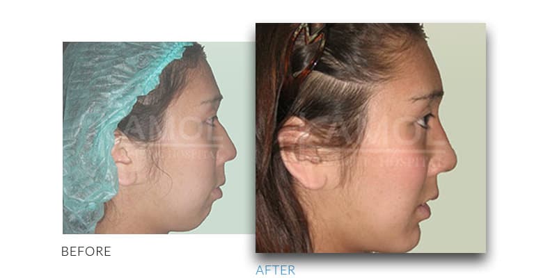 chin-shaving-reduction