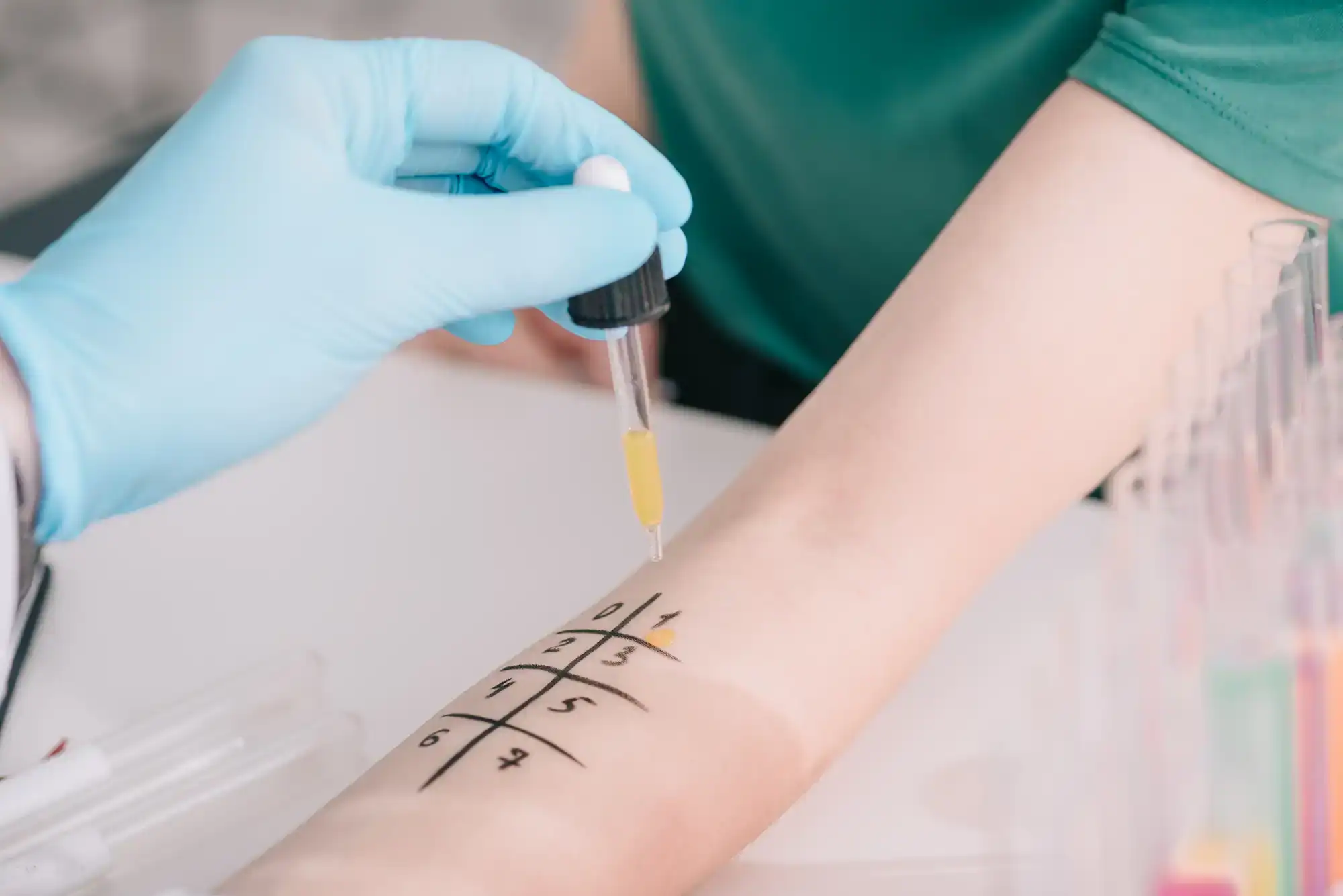 Allergology Munich cropped view of doctor in latex glove holding pipe
