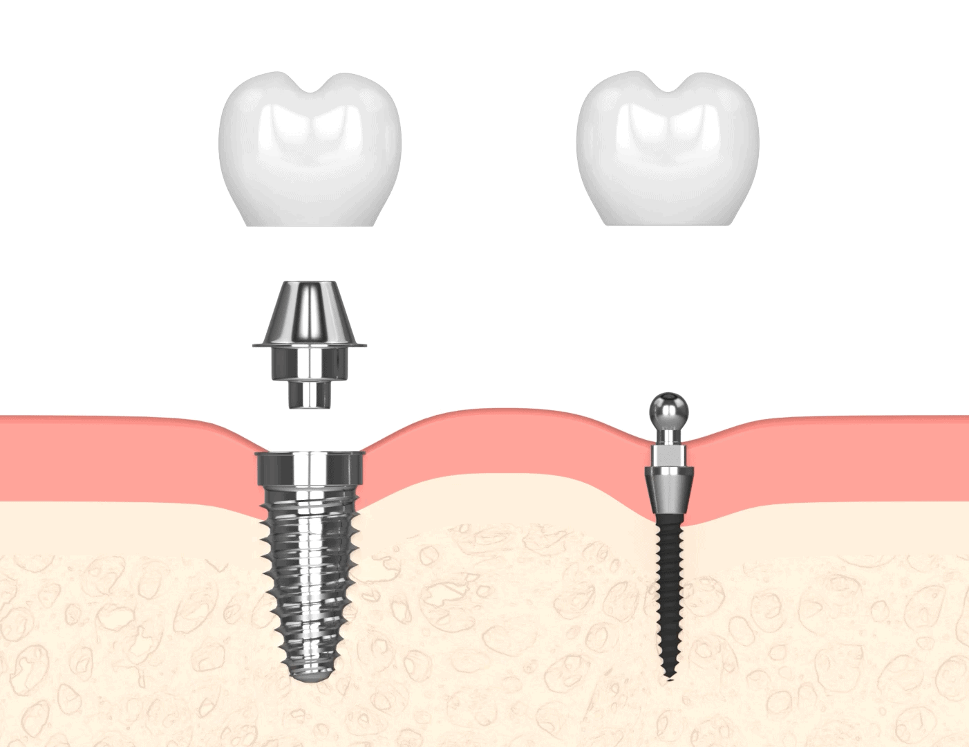 Implantes Dentales Asequibles en Liverpool, NY | Consultas Gratuitas de Implantes