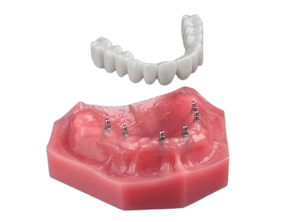 Fix-on-6 in North Carolina | Mini Implant Denture | Denture Options