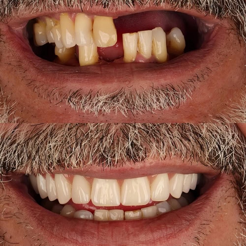 Mini Implants in Emeryville, CA | Book a Consultation | Dr. Magno