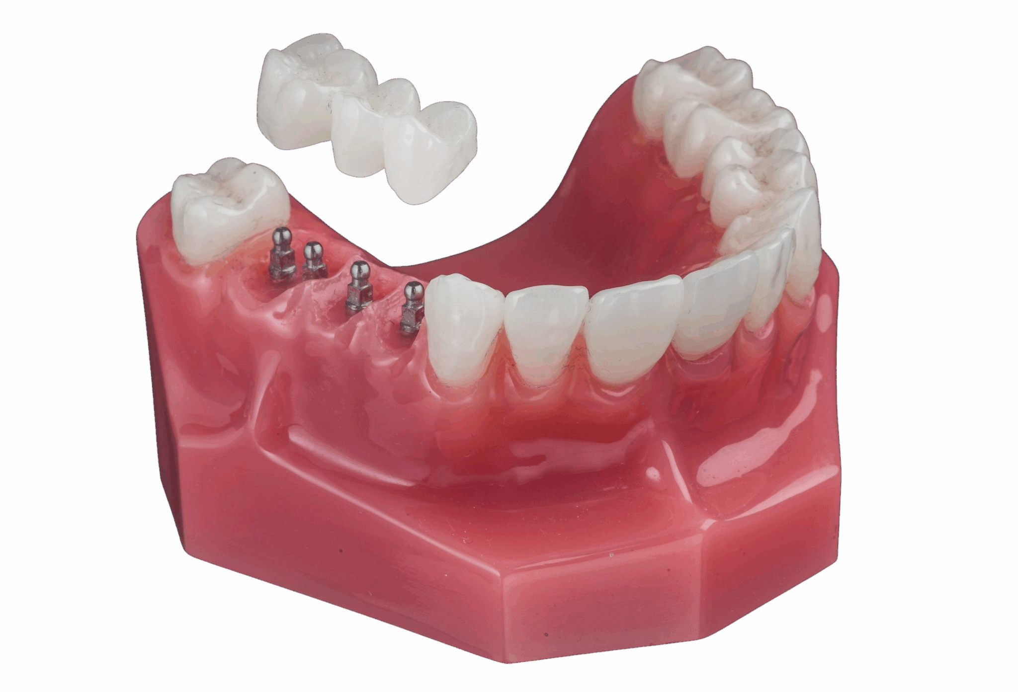 Dental implants in Orange County, NY Book a Free Consultation