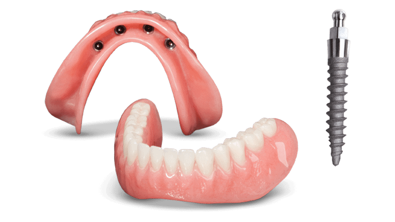 Denture Options in Kaysville, UT | Book an Implant Consultation