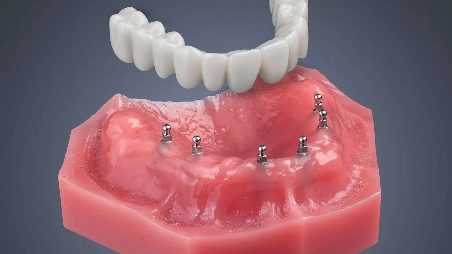 Dental Implant Treatment Mini Dental Implants in Union City, NJ