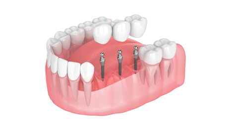 Implant Bridge in Union City, NJ | Mini Implants | Free Consultations