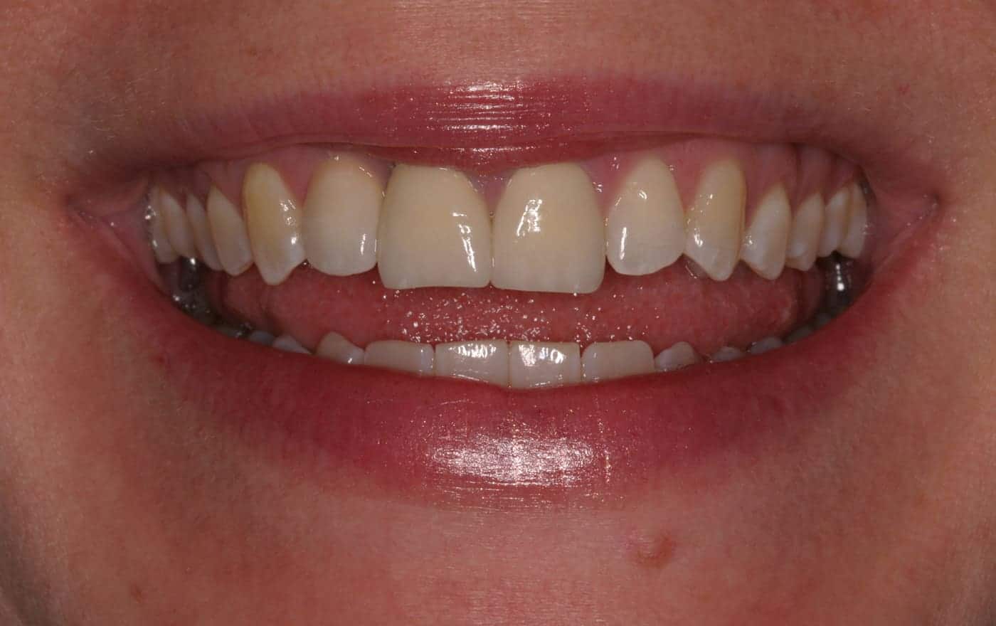 dental implants single tooth, removable partial dentures