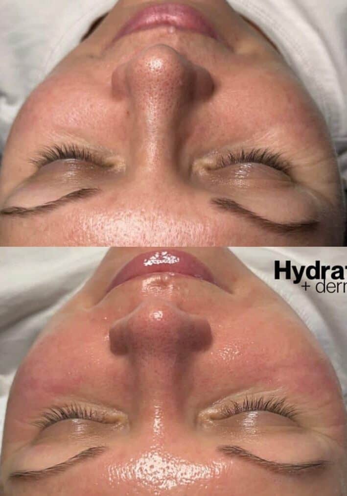 hydrafacial before and after 1024x1013 hydrafacial before and after 1024x1013