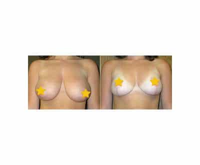 breast-reduction2_mini