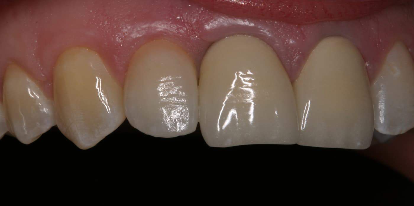 single tooth replacement, dental implants single tooth