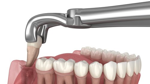 Dental Extraction in East Longmeadow, MA | Free Consultations