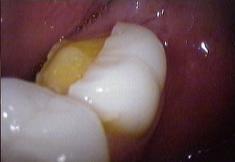 porcelain veneers beverly hills  porcelain veneers beverly hills