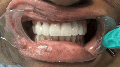 Mini Dental Implants in Scottsdale, AZ Dr. Seerat Mann