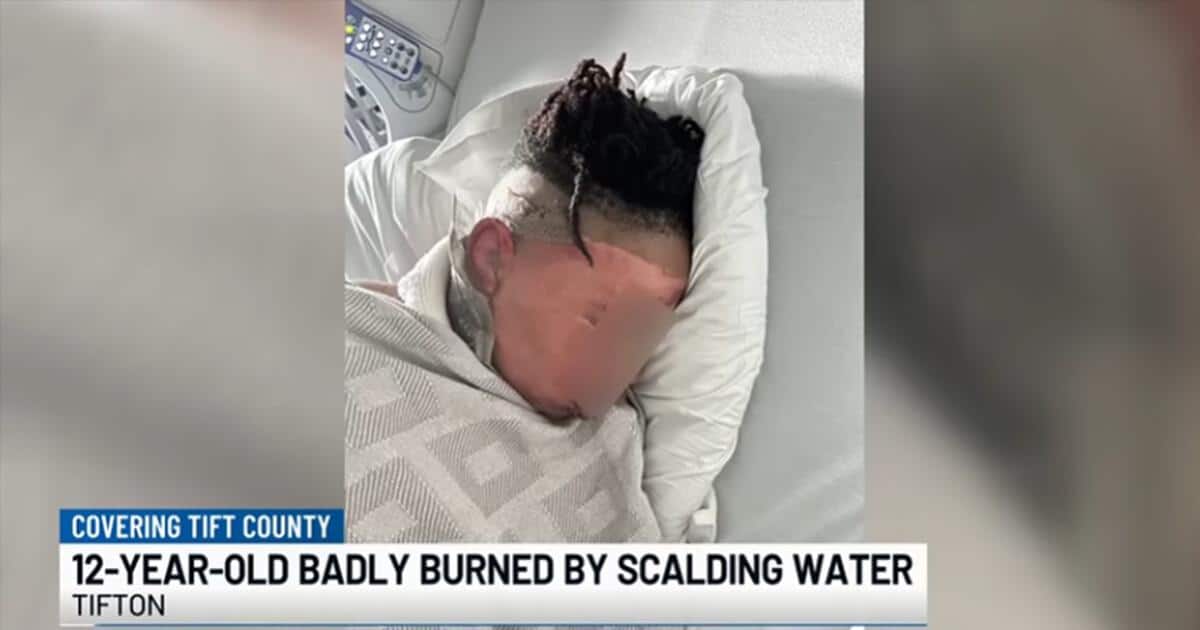 A 12-year-old boy lies in a hospital bed, severely burned from a sleepover incident. His face is visibly injured, with significant burns from boiling water. The image relates to the story of a Georgia boy hurt by a prank.