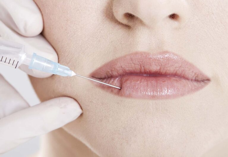 Augmentation volume des lèvres à Paris