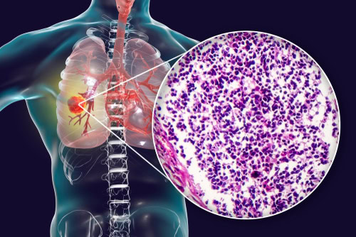 Malignant Mesothelioma Attorneys - Lipsitz, Ponterio & Comerford - Asbestos Exposure Lawyers