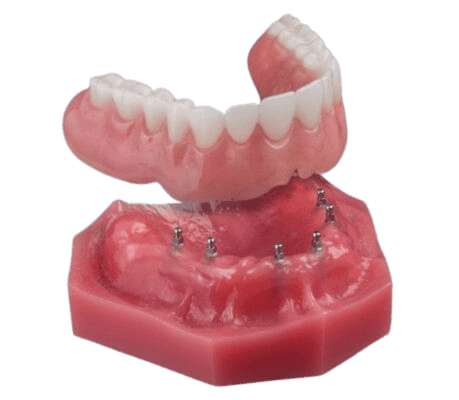 Snap In Dentures in Buffalo, NY | Book Your Free Consultation!