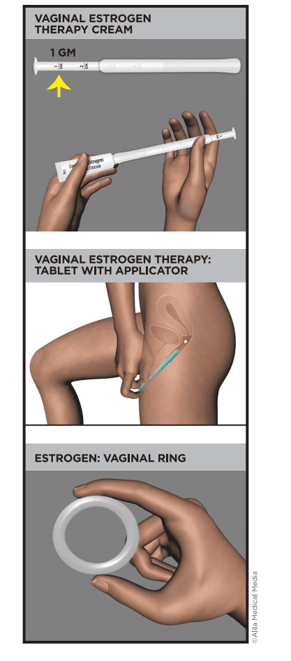 Vaginal Estrogen Therapy