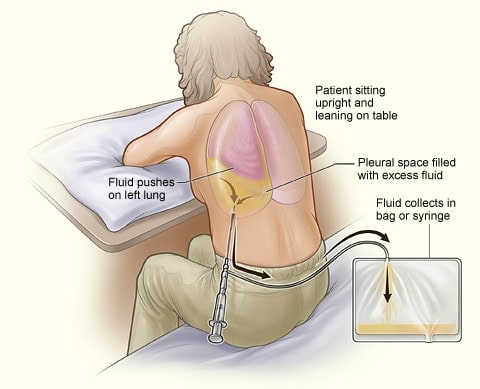 Pleurocentesis Surgery for Mesothelioma Patients | Thoracentesis