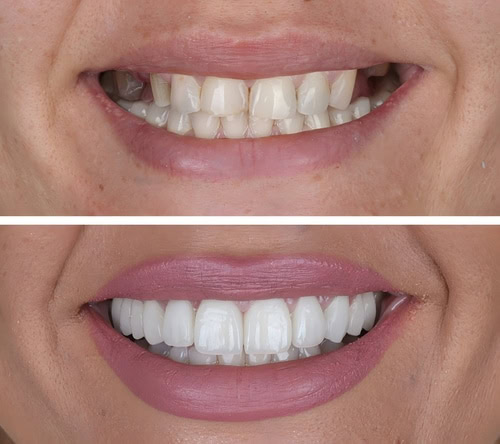 Cosmetic Dentistry in Winston-Salem, NC | Book a Consultation