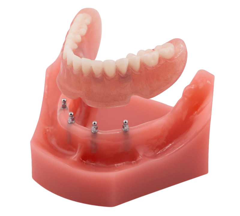 All on Four | Implant Dentures in Butler, PA | Brockley Dental Center