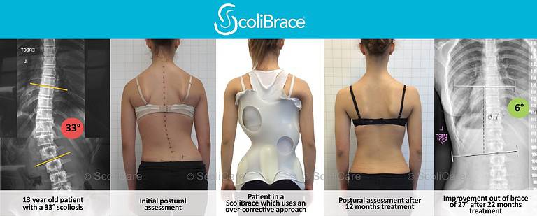 Scoliosis Center of LA and Chiropractic for Acadiana 27 in out