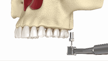 Sinus Lift in Cleveland, TN | The Sinus Bump Process