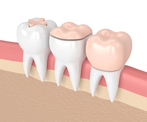 Dental Onlay in Buffalo, NY | Restore & Protect Your Smile Today