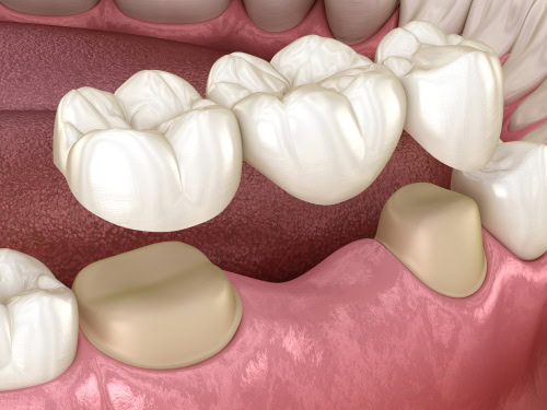 Puentes dentales en Union City, NJ - Puente,dental,de,3,dientes,sobre,molar,y,premolar.,Médicamente
