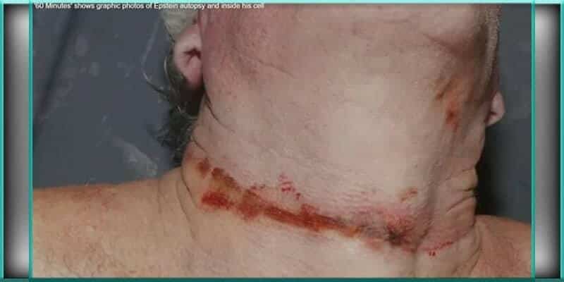 Graphic image from the Epstein autopsy, showing a close-up of the neck with a prominent, thin bloody line and other neck injuries. This image is featured in the "60 Minutes" segment on Epstein autopsy photos, raising questions about the Jeffrey Epstein death.