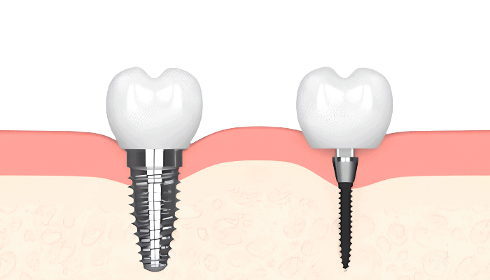 New Teeth in Wayne, NJ Mini Implants Book a Free Consultation!